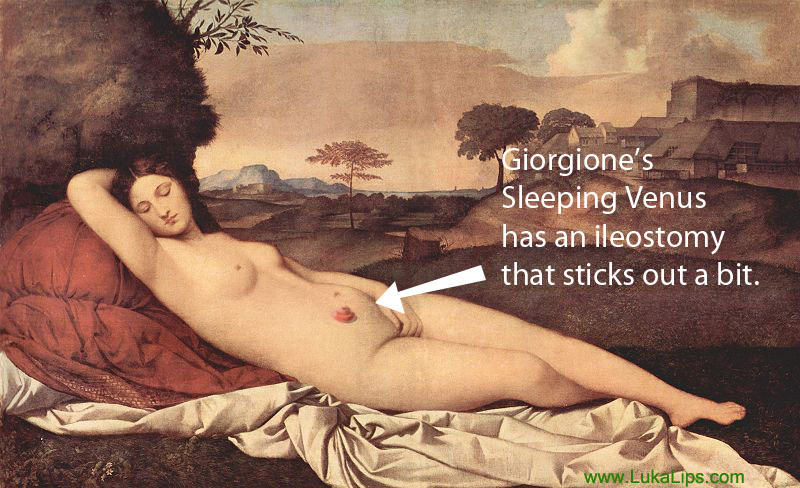 Giorgione sleeping Venus with ileostomy